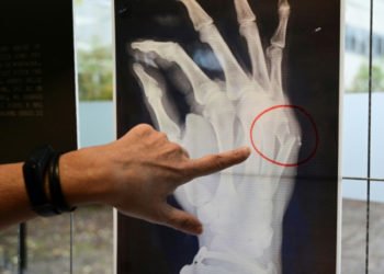 X-rays of broken bones